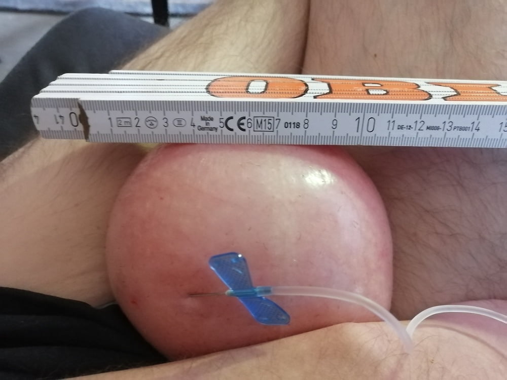 Saline Infusion In Scrotum First Try 1 Liter 25 Pics XHamster