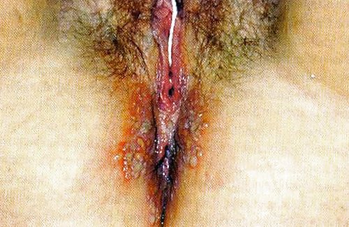 Porn image Chlamydia Australian Fat Pig