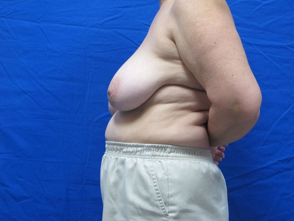 Breast reduction surgery after mastectomy-5599