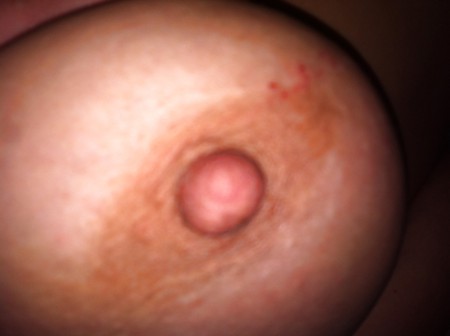 Left Nipple