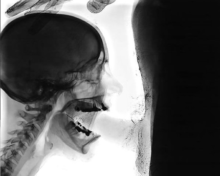 throat x ray Deep