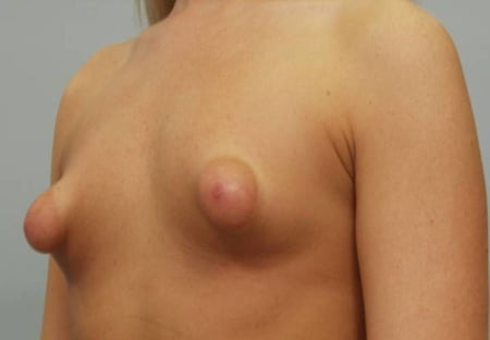 Puffy And Malformed Tits Lovely Areolas Plastic Surgery Pics Xhamster