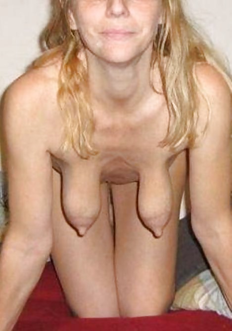 Inverted nipple and big nipple