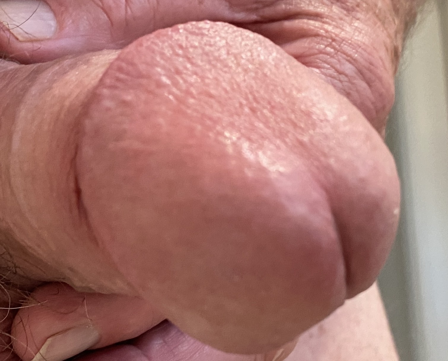 Hypospadias Cock 62 Pics XHamster