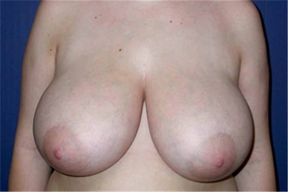 Breast augmentation and reduction in breastfeeding